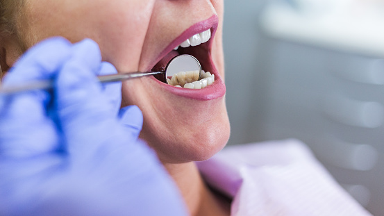 Close up of dentist examining a patient's mouth with a dental mirror.