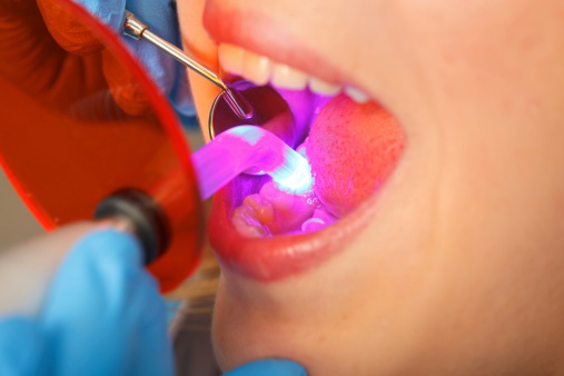 Dentist working with dental polymerization lamp in oral cavity.