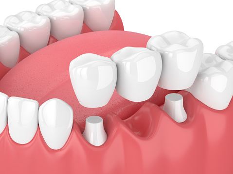 Dental bridge being placed in diagram of lower teeth.