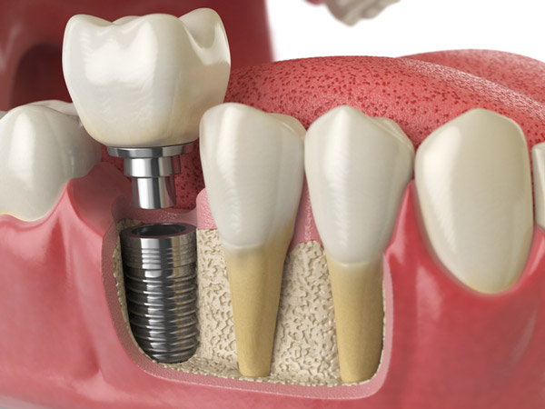 Diagram of dental implant into jaw bone.