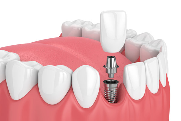 Dental Implants Newport