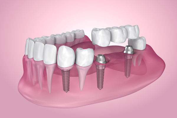 3D rendering of mouth with multiple dental implants
