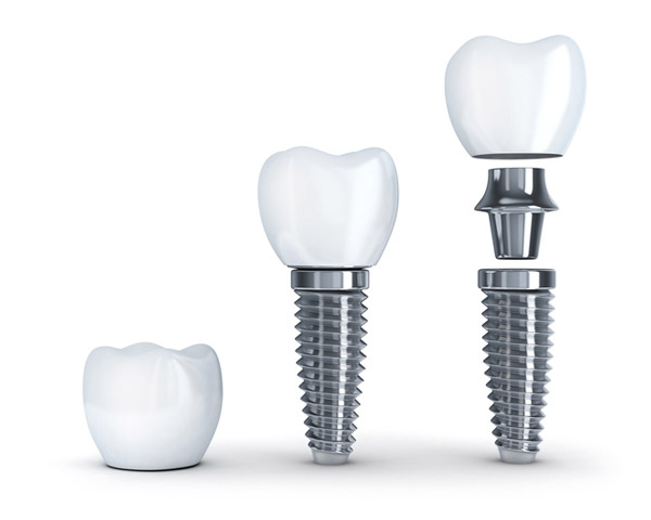Diagram of dental implant with post.