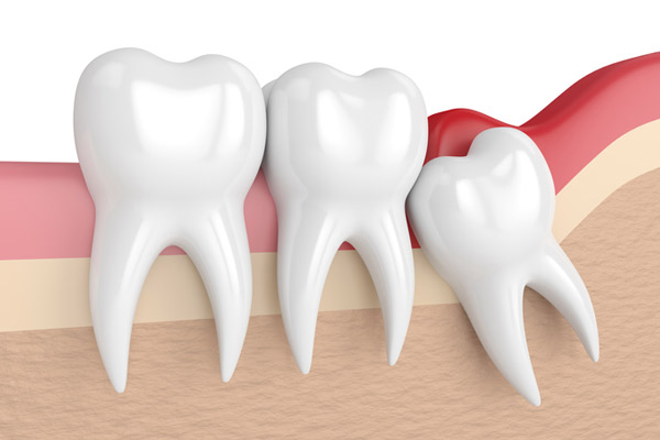 Illustration of an impacted wisdom tooth.